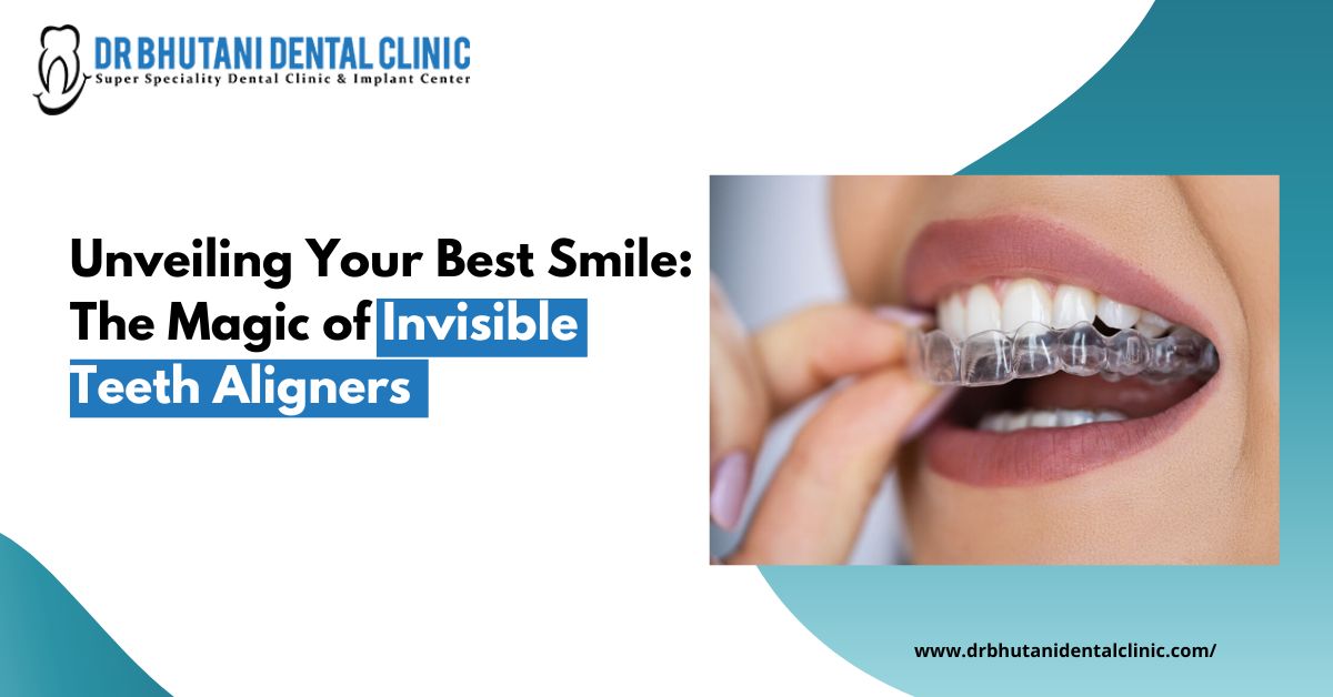 Unveiling Your Best Smile: The Magic of Invisible Teeth AlignersHealth and BeautyHealth Care ProductsNorth DelhiPitampura