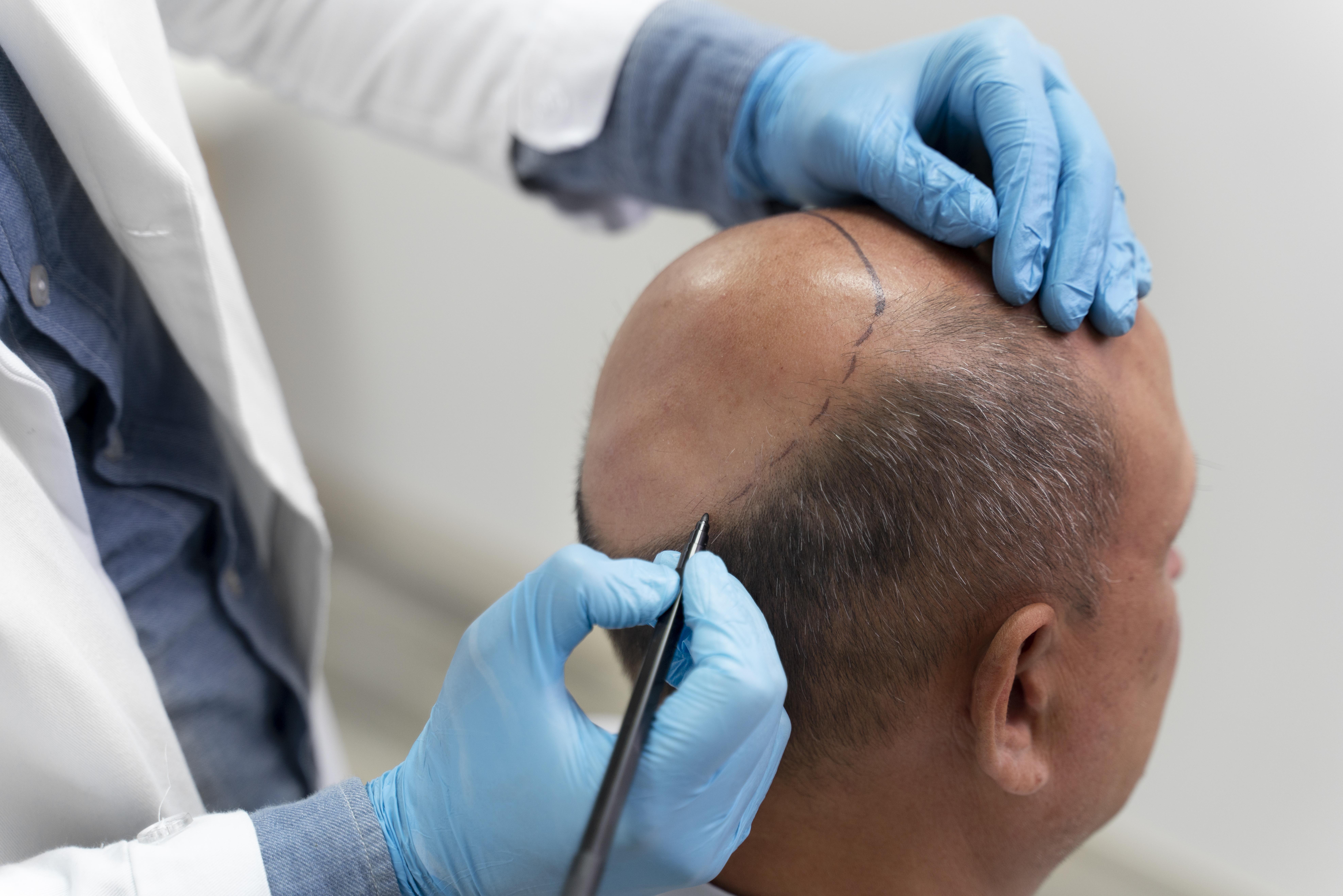 Best Hair Transplant in Mumbai | Hair Transplant Cost in MumbaiHealth and BeautyHealth Care ProductsAll Indiaother