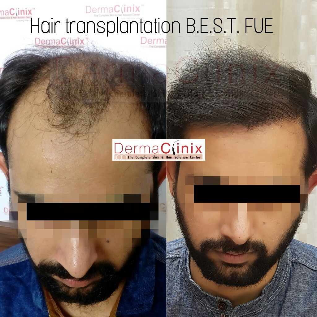 Hair Transplant Doctor in Delhi