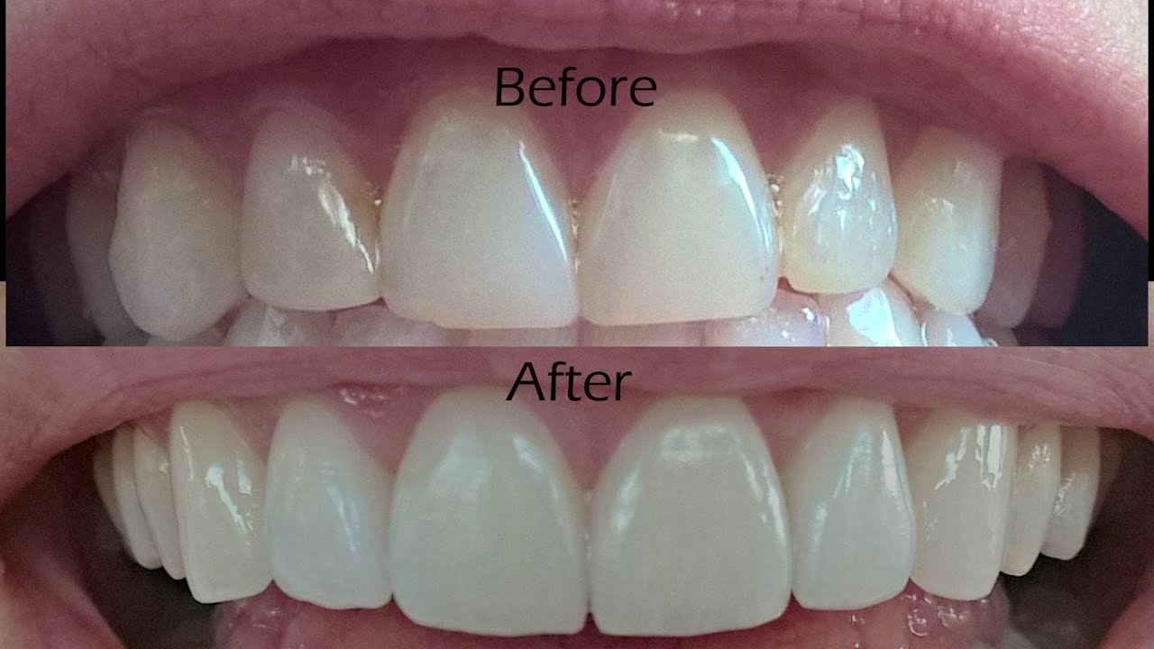 Dental veneers in MumbaiHealth and BeautyAll India