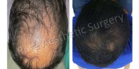 Hair Plantation DelhiHealth and BeautyCosmeticsCentral DelhiOther