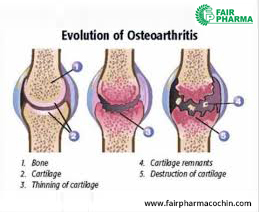 Ayurvedic treatment for arthritis