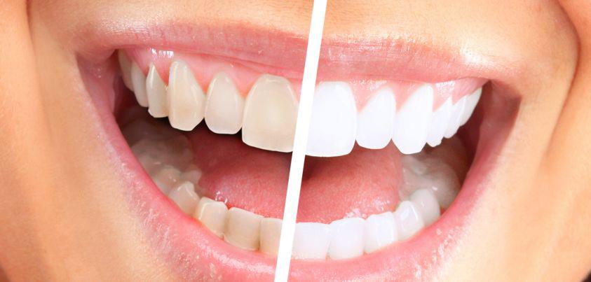 best tooth whitening in delhiServicesHealth - FitnessEast DelhiPreet Vihar