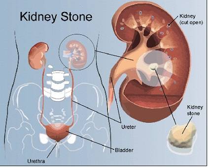 Kidney Stone Treatment in DelhiServicesHealth - FitnessSouth DelhiMunirka