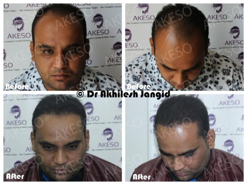 Excellent Hair Transplant Doctor in Delhi