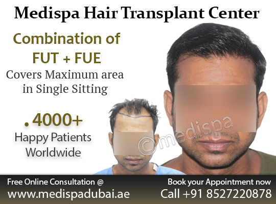 Best Hair Transplant in DelhiHealth and BeautyClinicsSouth DelhiGreater Kailash