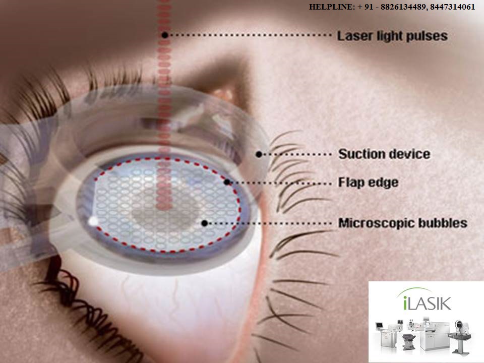 Lasik Laser Eye Surgery Cost in IndiaHealth and BeautyEye Care ProductsAll Indiaother