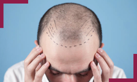 Hair transplant costHealth and BeautyClinicsAll Indiaother