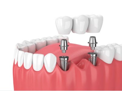Implant services in chennai - Akeela Dental CareServicesHealth - FitnessAll Indiaother