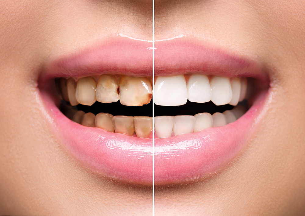 Teeth Cleaning &  Teeth Whitening - Eternal Smile.OtherAnnouncementsAll Indiaother