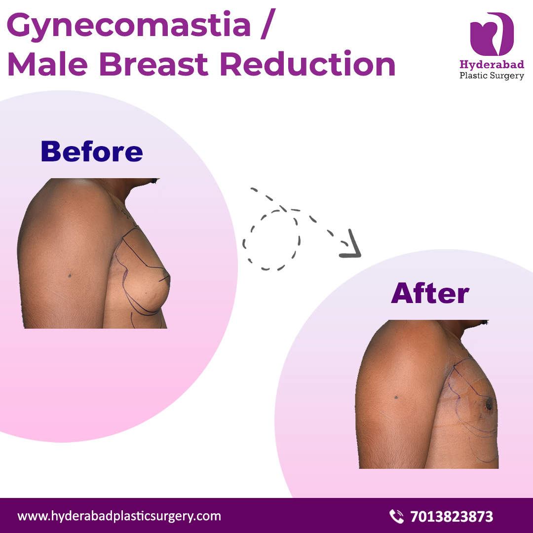 Best gynecomastia surgery in hyderabad
