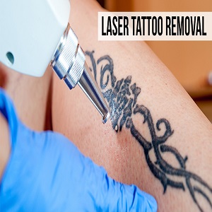 Tattoo removal treatment in HyderabadServicesHealth - FitnessSouth DelhiBhikaji Cama Place