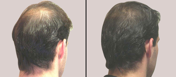 Mesotherapy / Stem Cell Therapy