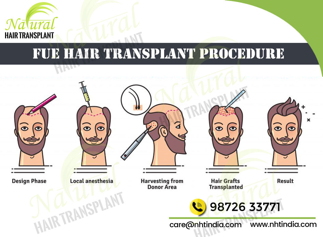 Best Hair Transplant Doctors in Chennai â€“ Cost & Clinic | NHTServicesHealth - FitnessAll Indiaother