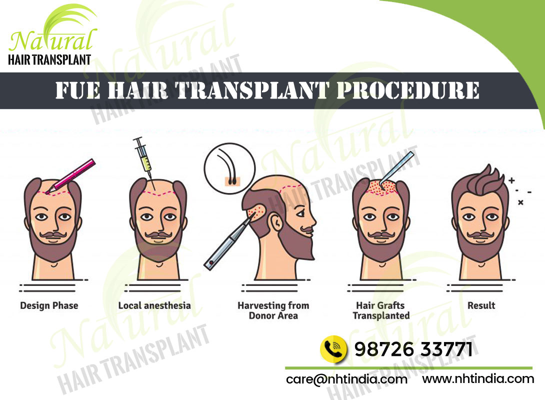 Best Hair Transplant Doctors in Chennai – Cost & Clinic | NHT