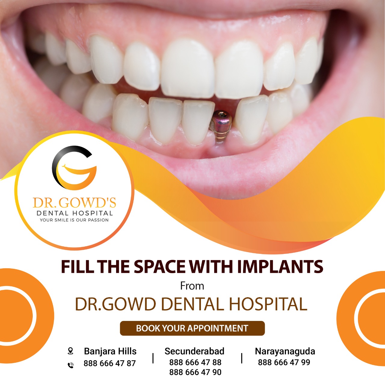 Best dental implant clinic in HyderabadHealth and BeautyHealth Care ProductsAll Indiaother