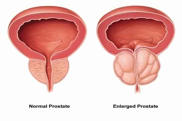Prostate Enlargement Treatment in New DelhiHealth and BeautyHospitalsSouth DelhiMunirka