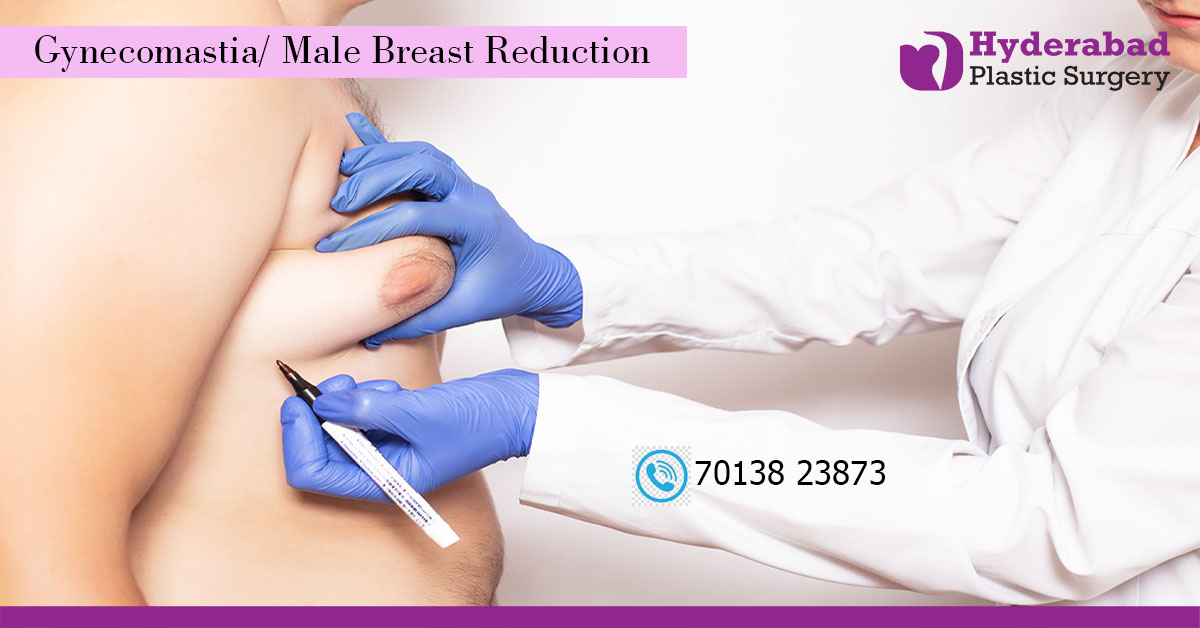 Best Gynecomastia Surgery in HyderabadHealth and BeautyHospitalsAll Indiaother