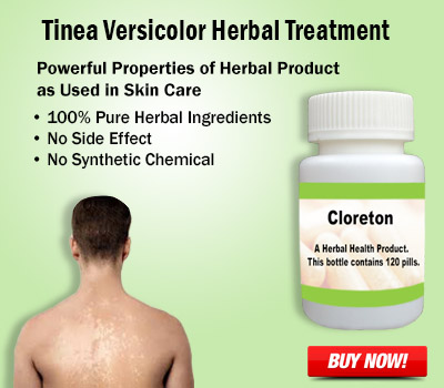 Natural Treatment for Tinea VersicolorHealth and BeautyHealth Care ProductsNoidaNoida Sector 11
