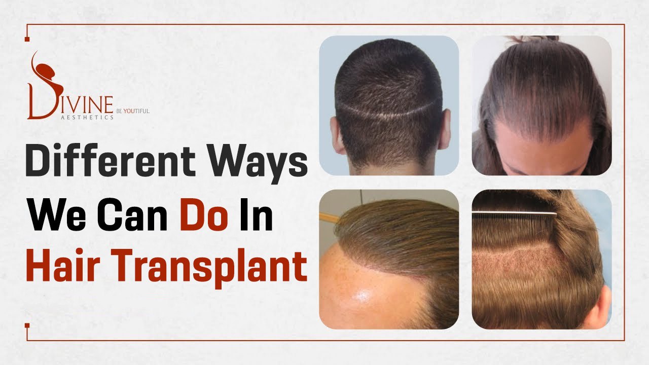 Different Ways we can do in Hair TransplantHealth and BeautyCosmeticsSouth DelhiGreater Kailash