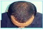 Complete Hair Fall Solution   Causes for Hair Loss:ServicesHealth - FitnessAll Indiaother