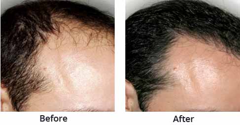 Hair Transplant Clinics in Kolkata