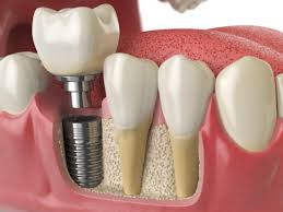 Dental Implants in AhmedabadHealth and BeautyCosmeticsAll Indiaother