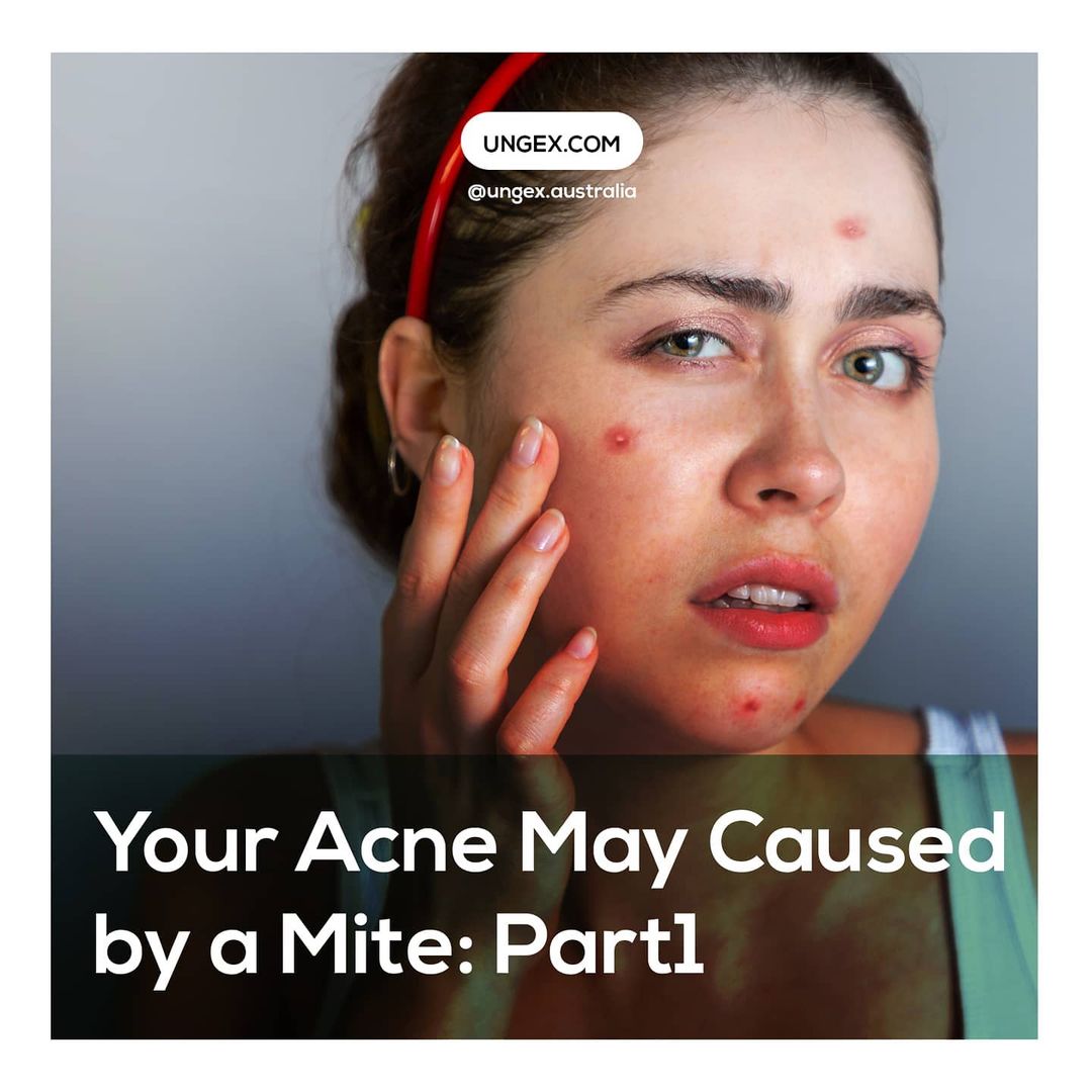 Your Acne May Caused by a Mite: Part1Health and BeautyHealth Care ProductsEast DelhiPark End