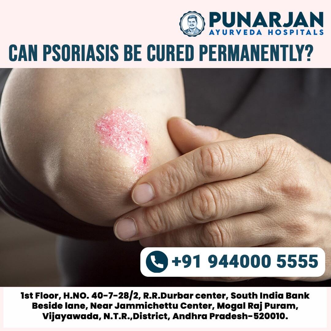 Best Psoriasis Treatment in VijayawadaHealth and BeautyHealth Care ProductsAll Indiaother