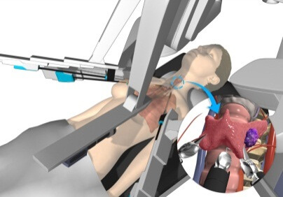 Robotic Thyroid Surgeon in Delhi