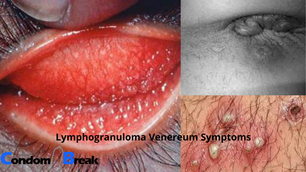 Lymphogranuloma Venereum Treatment in DelhiServicesHealth - FitnessSouth DelhiSaket