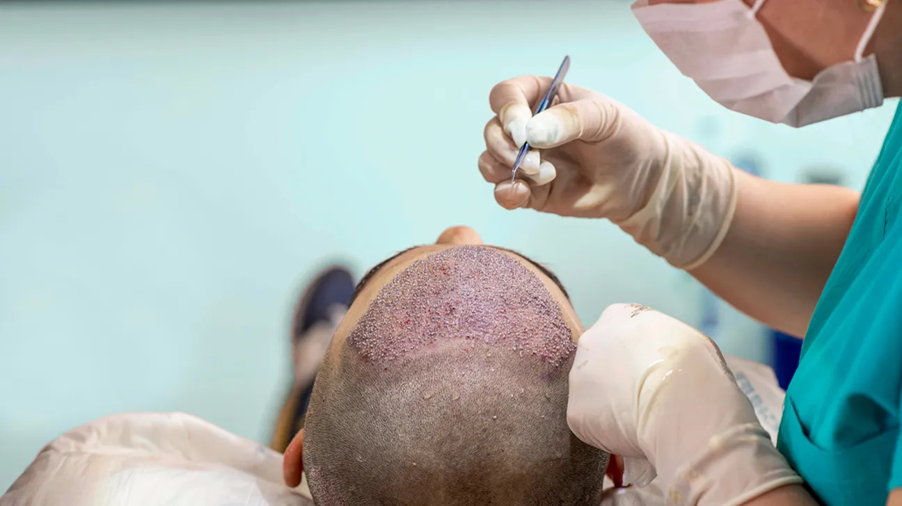 Best Hair Transplant in Delhi - Dr. Lokesh HandaHealth and BeautyCosmeticsAll Indiaother