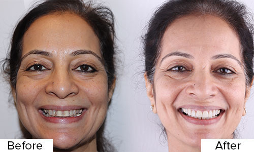Dental veneersHealth and BeautyClinicsAll Indiaother