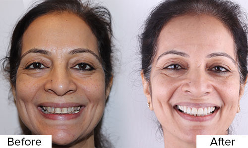 Dental veneers